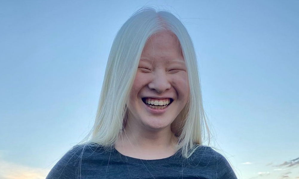 Girl Abandoned By Parents Because of Her Appearance Wants To Show The World They’re Wrong – Now A Model