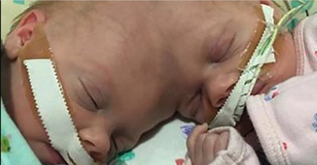 Conjoined twins Abby and Erin Delaney: Inside their remarkable story