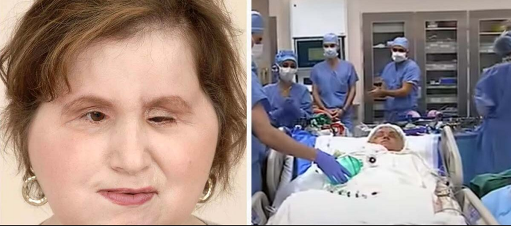 The amazing story of Katie Stubblefield: She became the youngest person to receive a face transplant