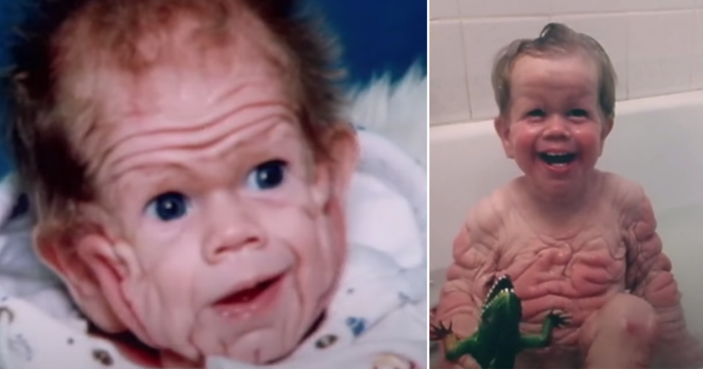 Tomm Tennent: The unique baby born with enough skin for a five-year-old child