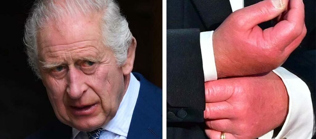 King Charles was bullied for his “sausage fingers” – medical reason behind revealed by expert